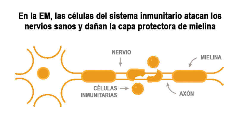Grafico de neurona atacada por linfocitos